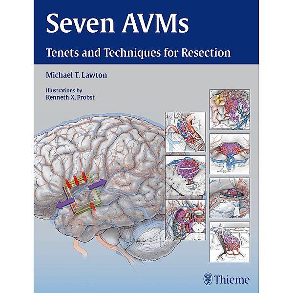 Seven AVMs, Michael T. Lawton