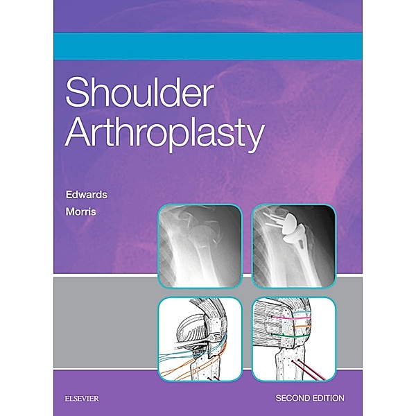 Shoulder Arthroplasty E-Book, T. Bradley Edwards, Brent J. Morris