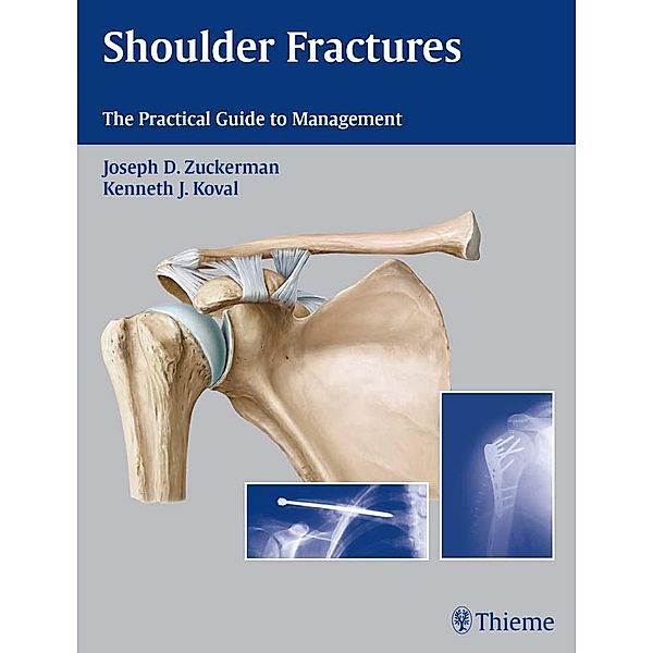 Shoulder Fractures