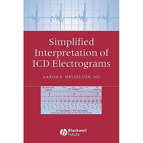 Simplified Interpretation of ICD Electrograms, Aaron B. Hesselson