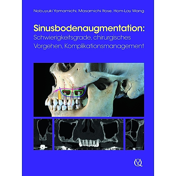 Sinusbodenaugmentation, Nobuyuki Yamamichi, Masamichi Itose, Hom-Lay Wang