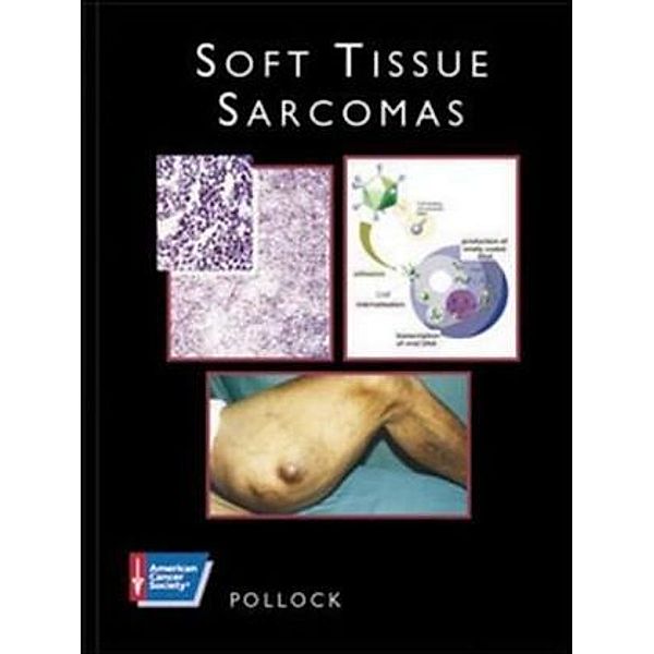 Soft Tissue Sarcomas, w. CD-ROM