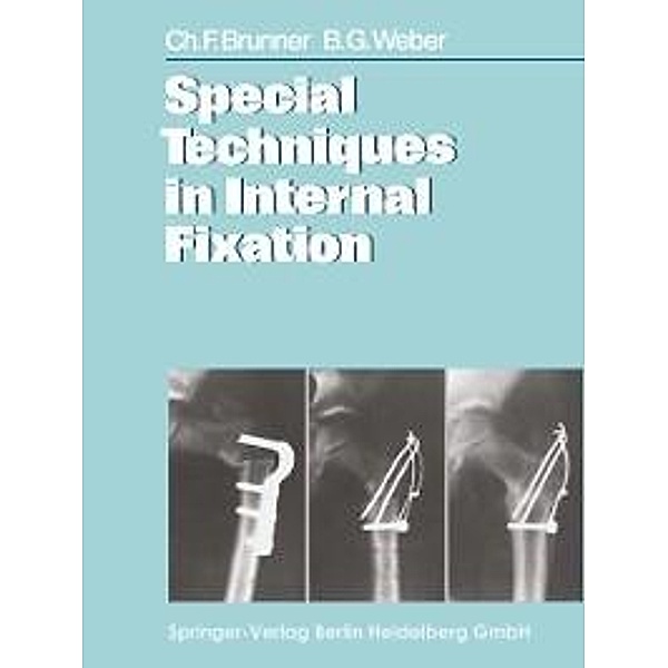 Special Techniques in Internal Fixation, C. F. Brunner, B. G. Weber