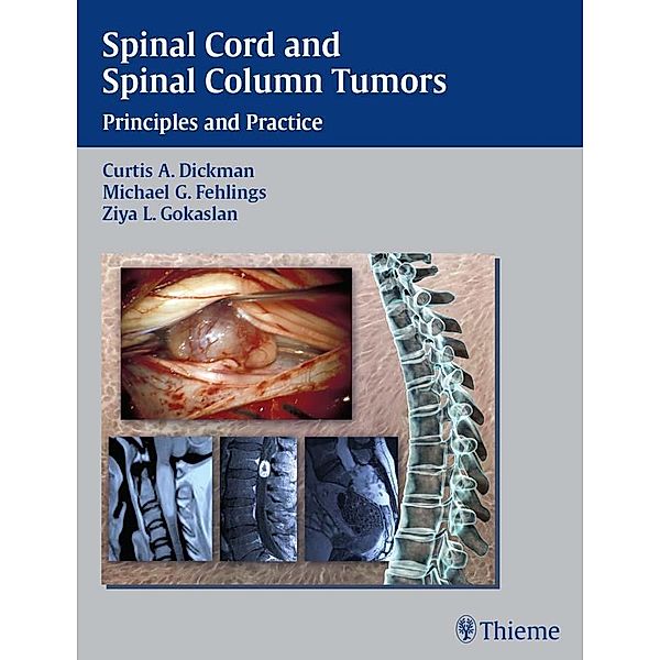 Spinal Cord and Spinal Column Tumors