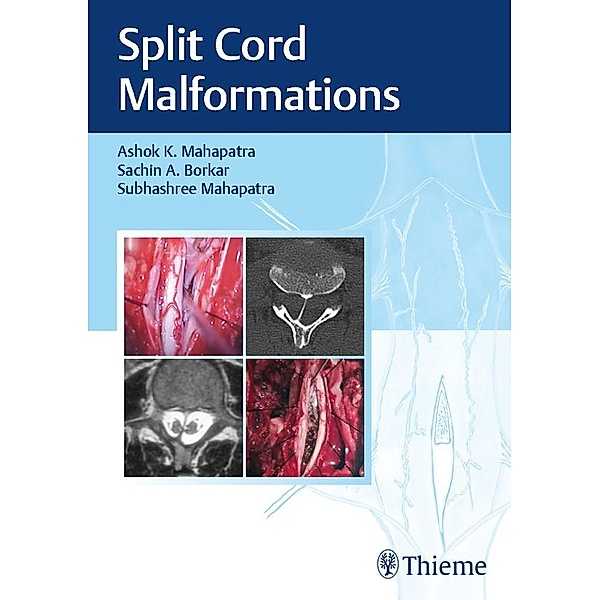 Split Cord Malformations, Ashok K. Mahapatra, Sachin A. Borkar, Subhashree Mahapatra