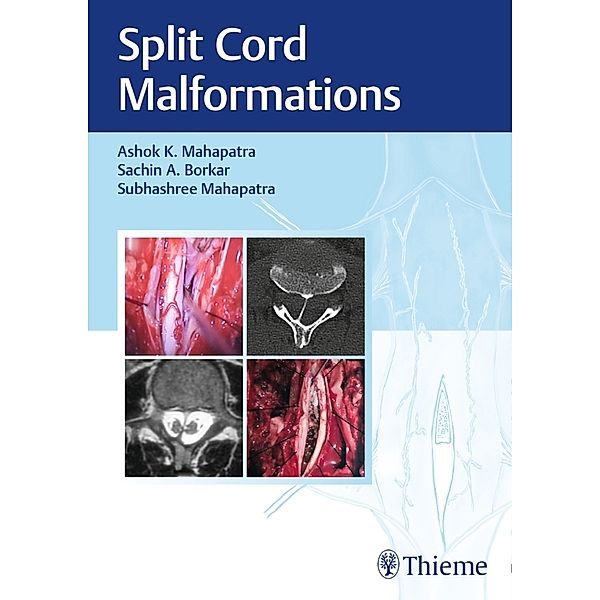 Split Cord Malformations, Ashok Mahapatra, Sachin Borkar, Subhashree Mahapatra
