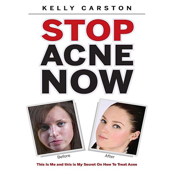 Stop Acne Now: This Is Me and This Is My Secret On How to Treat Acne, Kelly Carston