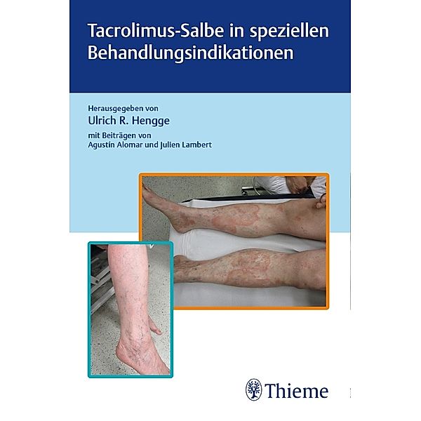 Tacrolimus-Salbe in speziellen Behandlungsindikationen