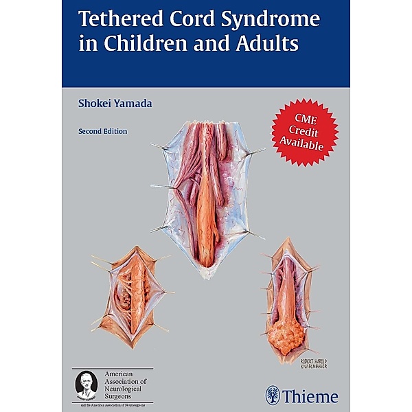 Tethered Cord Syndrome in Children and Adults