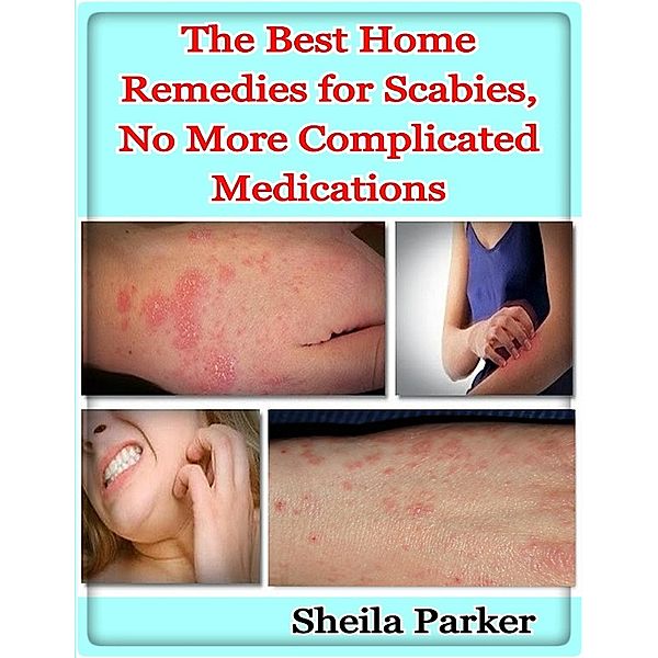 The Best Home Remedies for Scabies, No More Complicated Medications, Sheila Parker