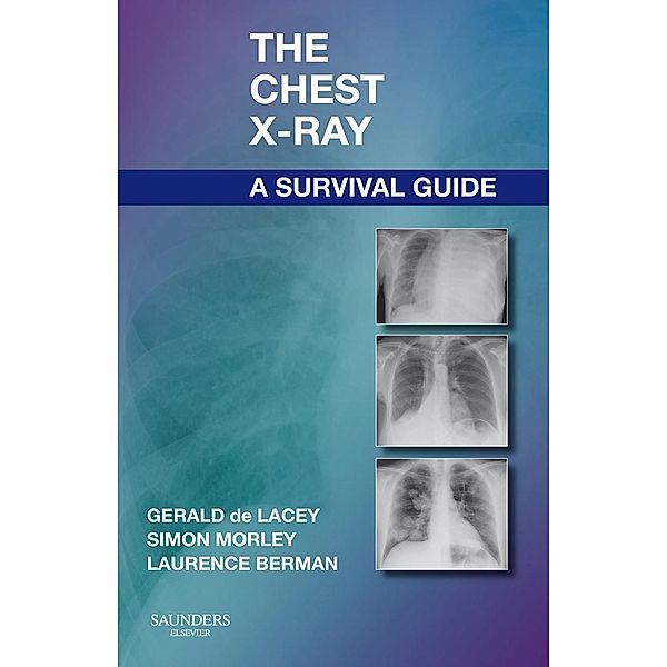 The Chest X-Ray: A Survival Guide, Gerald de Lacey, Simon Morley, Laurence Berman