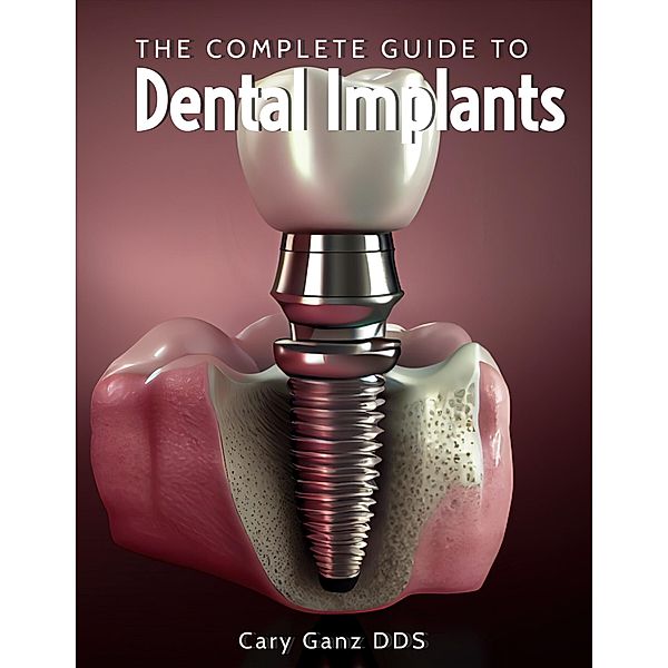 The Complete Guide to Dental Implants (All About Dentistry) / All About Dentistry, Cary Ganz D. D. S.