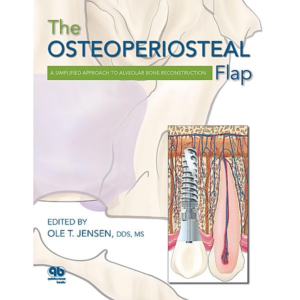 The Osteoperiosteal Flap, Ole T. Jensen
