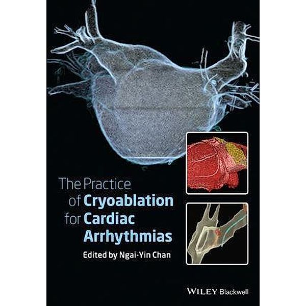 The Practice of Catheter Cryoablation for Cardiac Arrhythmias