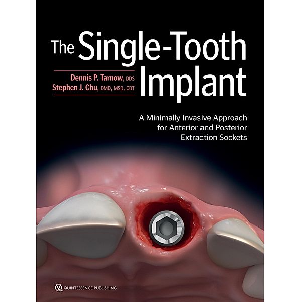 The Single-Tooth Implant:, Dennis P. Tarnow, Stephen J. Chu