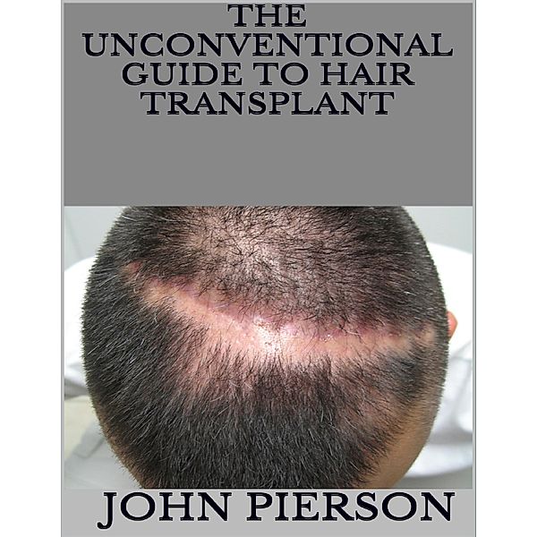 The Unconventional Guide to Hair Transplant, John Pierson