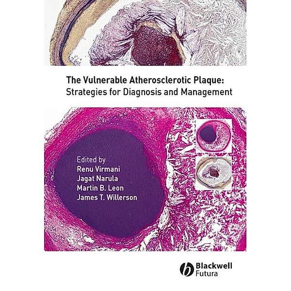 The Vulnerable Atherosclerotic Plaque