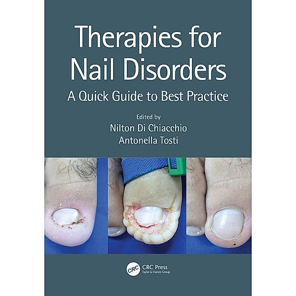 Therapies for Nail Disorders