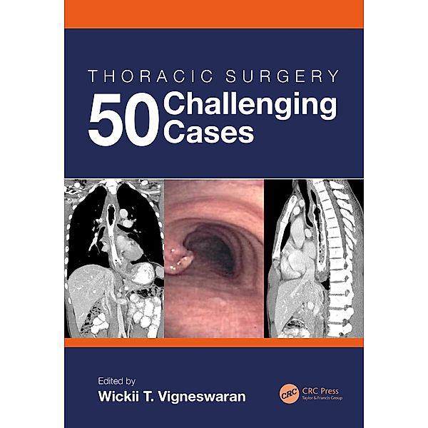 Thoracic Surgery: 50 Challenging cases