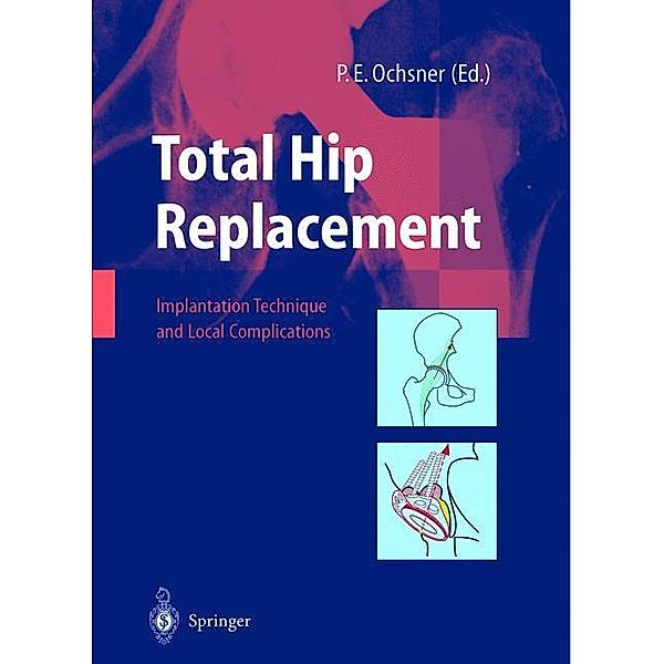 Total Hip Replacement