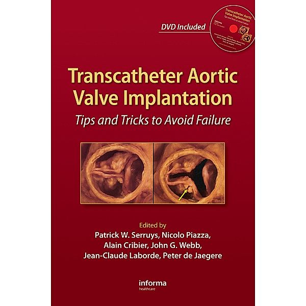 Transcatheter Aortic Valve Implantation