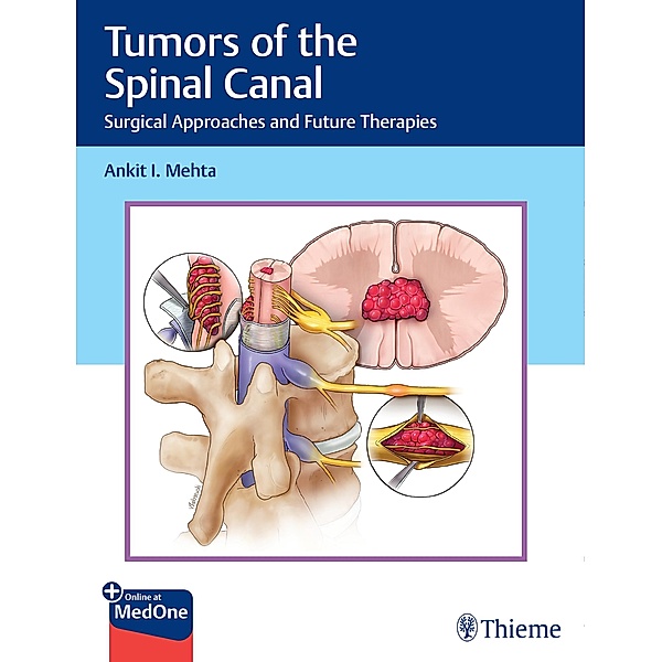 Tumors of the Spinal Canal, Ankit I. Mehta