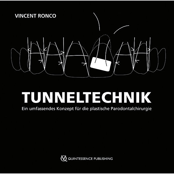 Tunneltechnik, Vincent Ronco