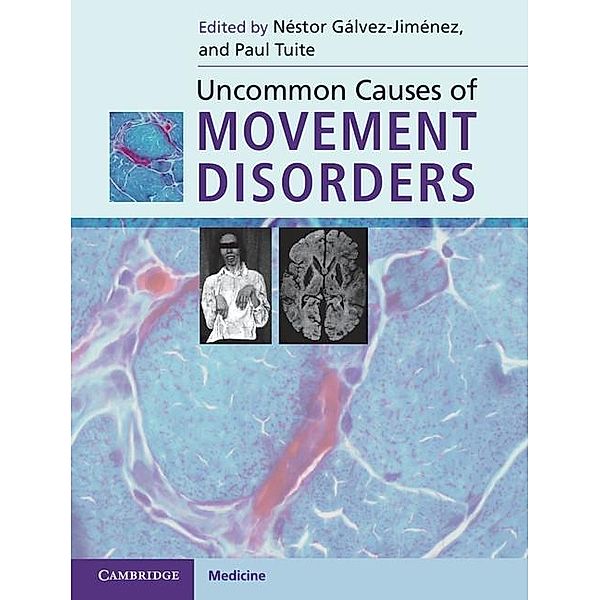 Uncommon Causes of Movement Disorders