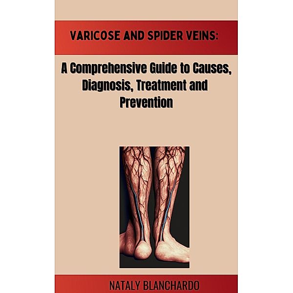 Varicose and Spider Veins: A Comprehensive Guide to Causes,Diagnosis, Treatment and Prevention, Nataly Blanchardo