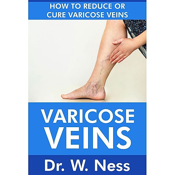 Varicose Veins: How To Reduce Or Cure Varicose Veins, W. Ness
