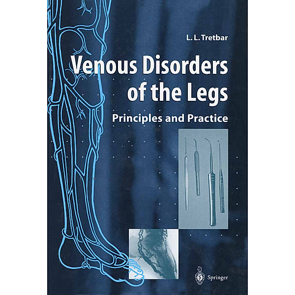 Venous Disorders of the Legs, Lawrence L Tretbar