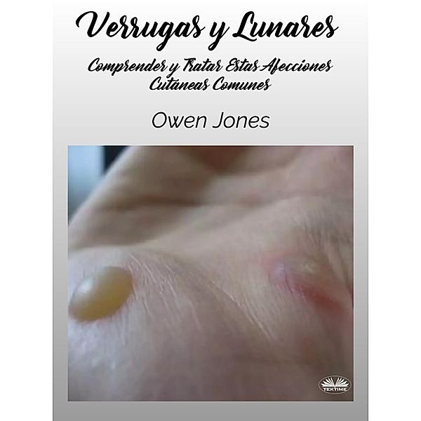 Verrugas Y Lunares, Owen Jones