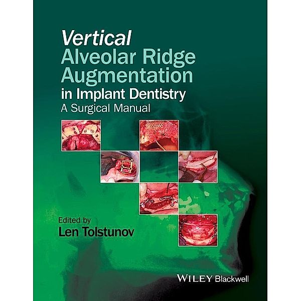 Vertical Alveolar Ridge Augmentation in Implant Dentistry