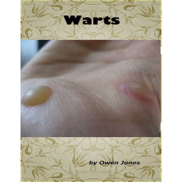 Warts, Owen Jones