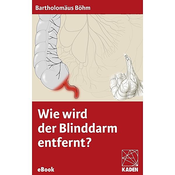 Wie wird der Blinddarm entfernt?, Bartholomäus Böhm