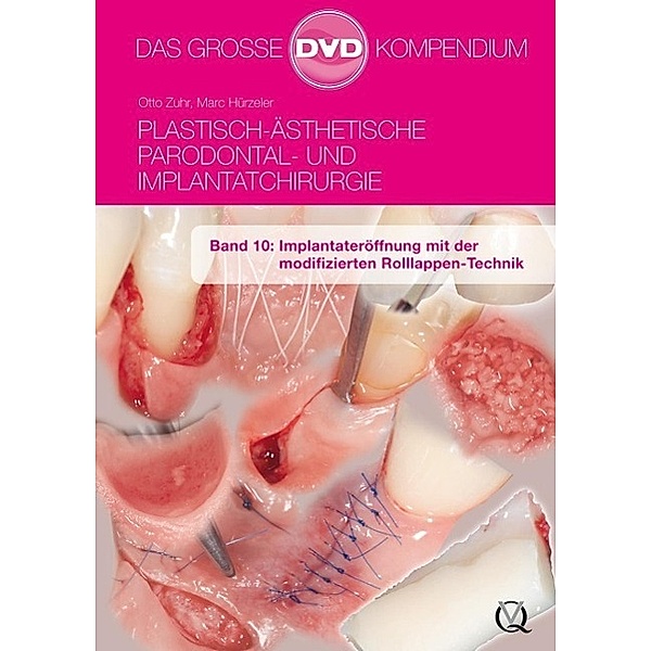 Zuhr: Plast.-Ästhetische Parodontal- und Implantatchir. 10, Otto Zuhr, Marc Hürzeler
