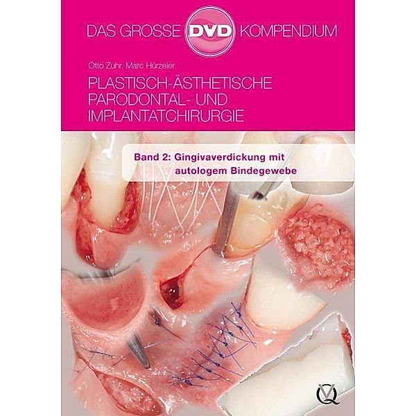 Zuhr: Plastisch-Ästhetische Parodontal- und Implantat. 2, Otto Zuhr, Marc Hürzeler