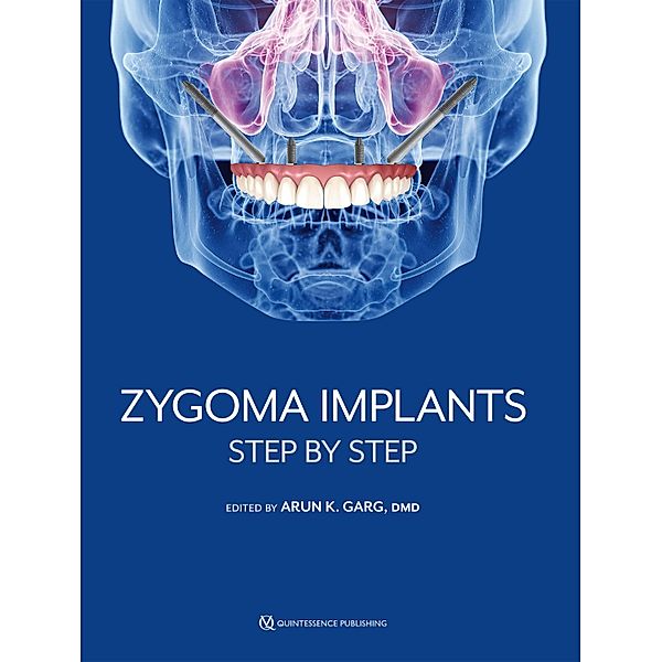 Zygoma Implants, Arun K. Garg